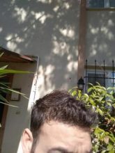 beard-hair-transplant (24)