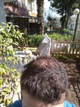 beard-hair-transplant (25)