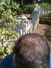 beard-hair-transplant (26)