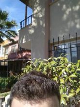 beard-hair-transplant (27)