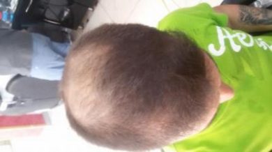 beard-hair-transplant (4)