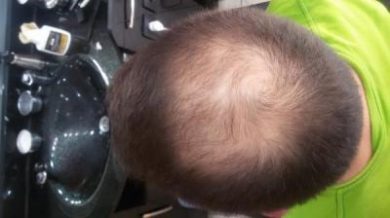 beard-hair-transplant (5)