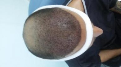 beard-hair-transplant (6)