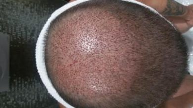 beard-hair-transplant (7)