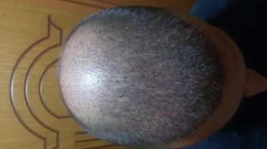 beard-hair-transplant (8)