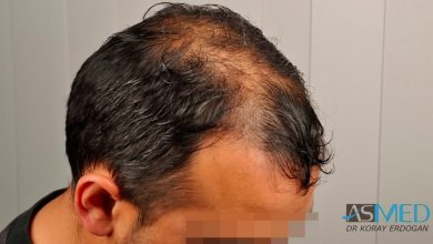 best-hair-transplant-turkey-fue (1)