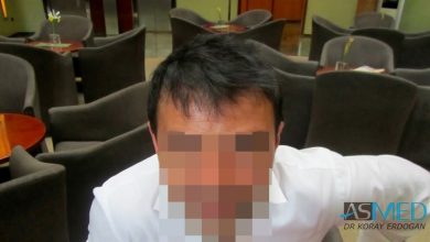 best-hair-transplant-turkey-fue (10)