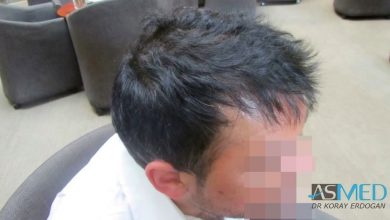 best-hair-transplant-turkey-fue (12)