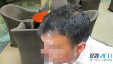 best-hair-transplant-turkey-fue (13)