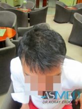 best-hair-transplant-turkey-fue (14)