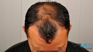 best-hair-transplant-turkey-fue (16)
