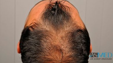 best-hair-transplant-turkey-fue (2)