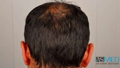 best-hair-transplant-turkey-fue (3)