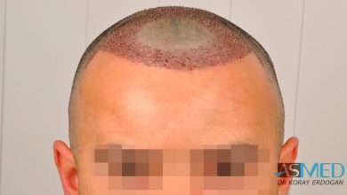 best-hair-transplant-turkey-fue (6)