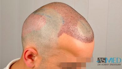 best-hair-transplant-turkey-fue (7)