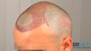 best-hair-transplant-turkey-fue (8)