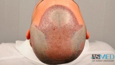 best-hair-transplant-turkey-fue (9)