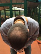 hair-implants-turkey (1)