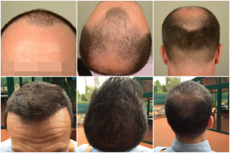 hair-implants-turkey (1)