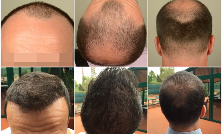 asmed-2600-grafts-fue-finasteride-hair-transplant-in-turkey