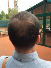 hair-implants-turkey (10)