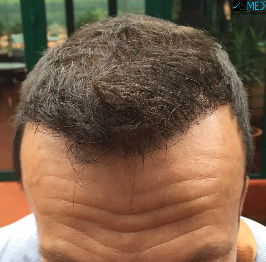 hair implants turkey