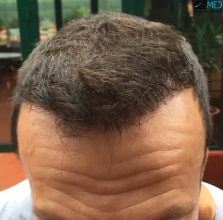 hair-implants-turkey (12)