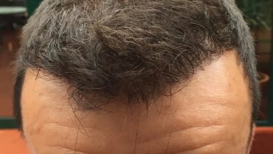 hair-implants-turkey (12)