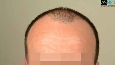 hair-implants-turkey (2)