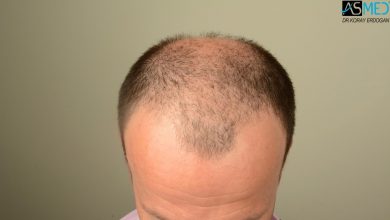 hair-implants-turkey (3)