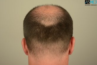 hair-implants-turkey (4)