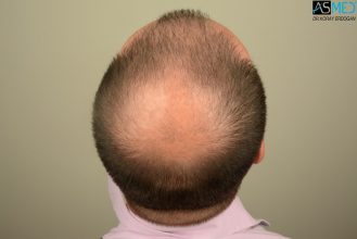 hair-implants-turkey (5)