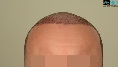 hair-implants-turkey (6)