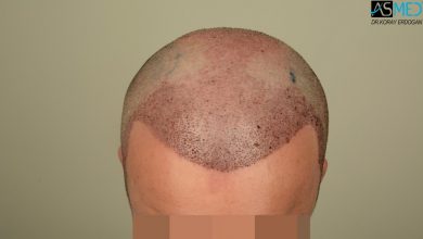 hair-implants-turkey (7)