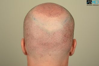 hair-implants-turkey (8)