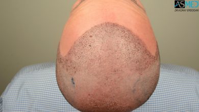 hair-implants-turkey (9)