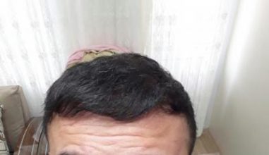 arenamed-hair-transplant (1)