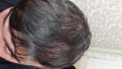 arenamed-hair-transplant (19)