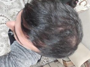arenamed-hair-transplant (3)