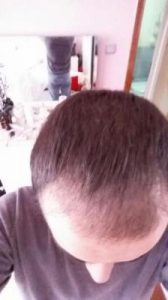 emrah-cinik-hair-transplant-result (1)