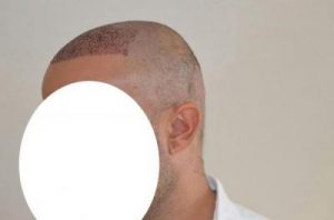 emrah-cinik-hair-transplant-result (10)