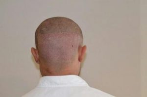 emrah-cinik-hair-transplant-result (11)