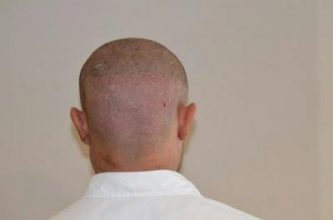 emrah-cinik-hair-transplant-result (11)