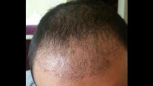 emrah-cinik-hair-transplant-result (12)