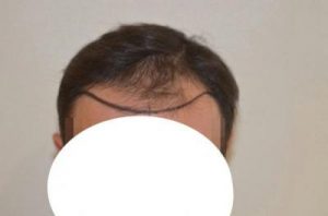 emrah-cinik-hair-transplant-result (5)