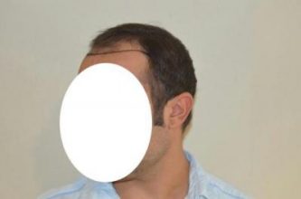 emrah-cinik-hair-transplant-result (6)
