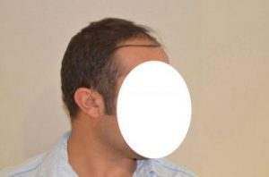 emrah-cinik-hair-transplant-result (7)