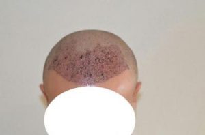 emrah-cinik-hair-transplant-result (8)