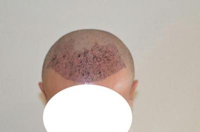 emrah-cinik-hair-transplant-result (8)