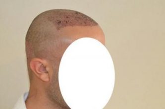 emrah-cinik-hair-transplant-result (9)